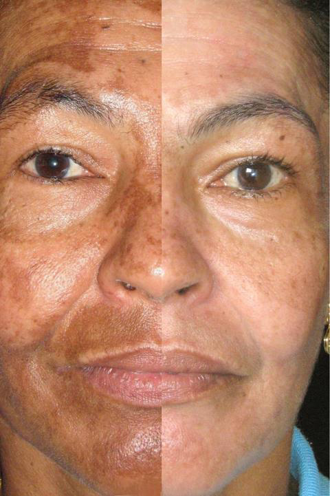 Peeling de Oli Ola em cápsulas – Mesmos benefícios dos peelings químicos e físicos na pele – A revolução em nutricosméticos