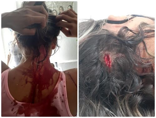 Jovem de Santa Terezinha é agredida brutalmente por seu companheiro; veja fotos