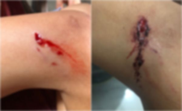 Mais uma criança é atacada por cães em Santa Terezinha-PB; mãe pede providência às autoridades