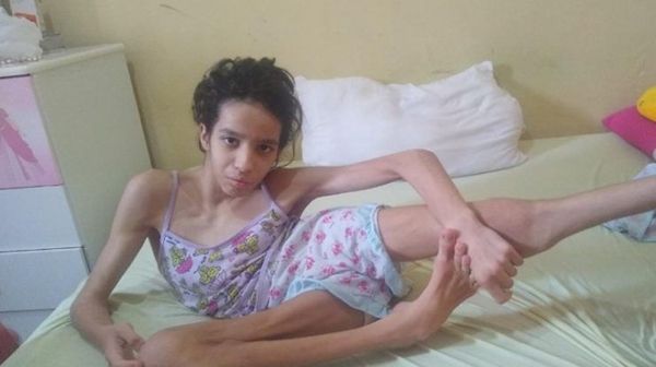 Esperança: pequena Maísa, de 12 anos de Matureia-PB irá realizar sua cirurgia dia 19 de julho; veja 
