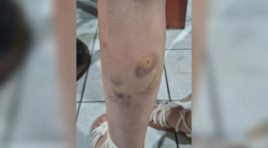 Jovem é atacada por cães no bairro Novo Horizonte, em Patos, e precisa tomar vacinas após o incidente